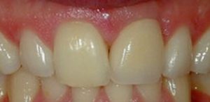 nassau-dental-Treatment-after